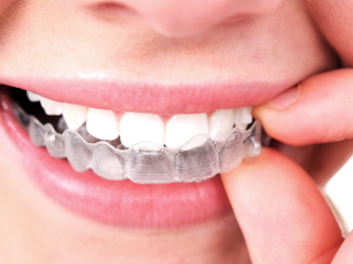 Invisalign Teeth Straightening